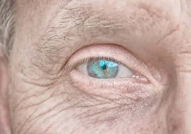Objawy zaćmy korowej: Jak rozpoznać i uniknąć pogorszenia wzroku