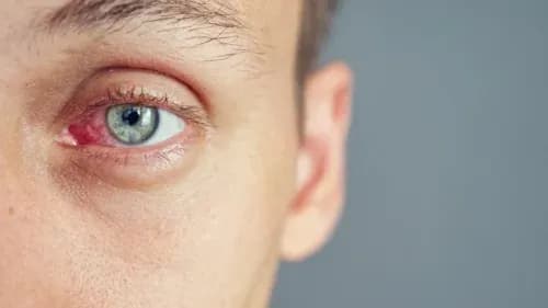 Jak zez rozbieżny wpływa na widzenie i codzienne życie osób z egzotropią