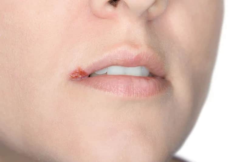 Czy można iść do dentysty z opryszczką? Sprawdź, jakie są ryzyka