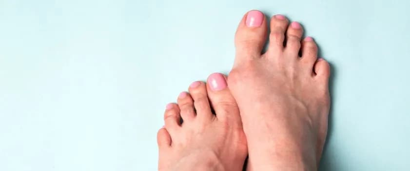 Jak rozpoznać haluksa: objawy, które mogą prowadzić do bólu
