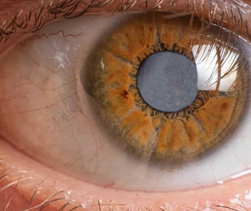 Zaćma pourazowa objawy – jak je rozpoznać i uniknąć pogorszenia wzroku