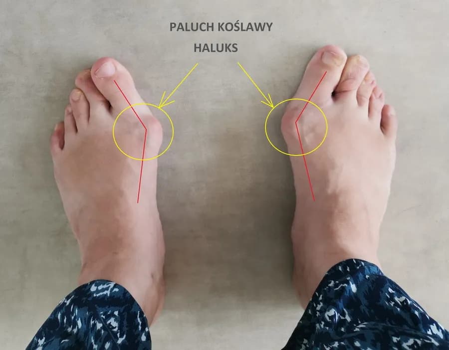 Jak uniknąć haluksów - skuteczne sposoby na zapobieganie bólowi stóp