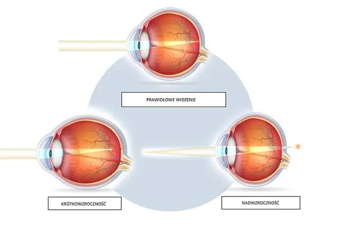 Jakie są wady wzroku? Poznaj objawy i skuteczne metody korekcji