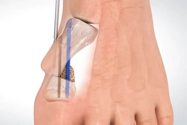 Operacja haluksa na czym polega? Poznaj metody i oczekiwania po zabiegu