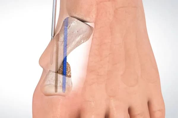 Operacja haluksa na czym polega? Poznaj metody i oczekiwania po zabiegu