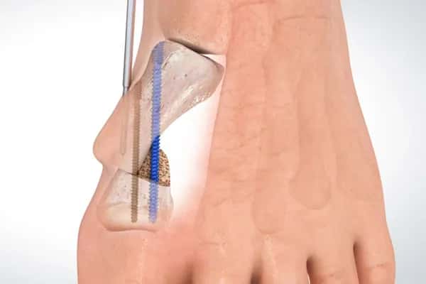 Operacja haluksa na czym polega? Poznaj metody i oczekiwania po zabiegu