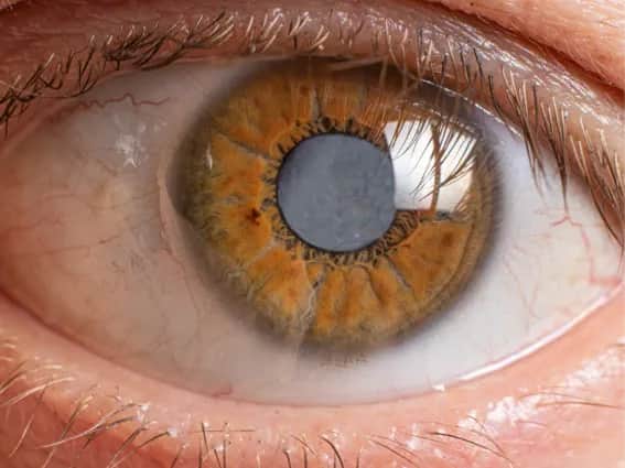 Dlaczego po operacji zaćmy widzę przez mgłę? Oto najczęstsze przyczyny