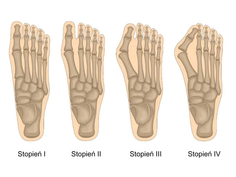 Jak wygląda haluks? Objawy i cechy, które warto znać