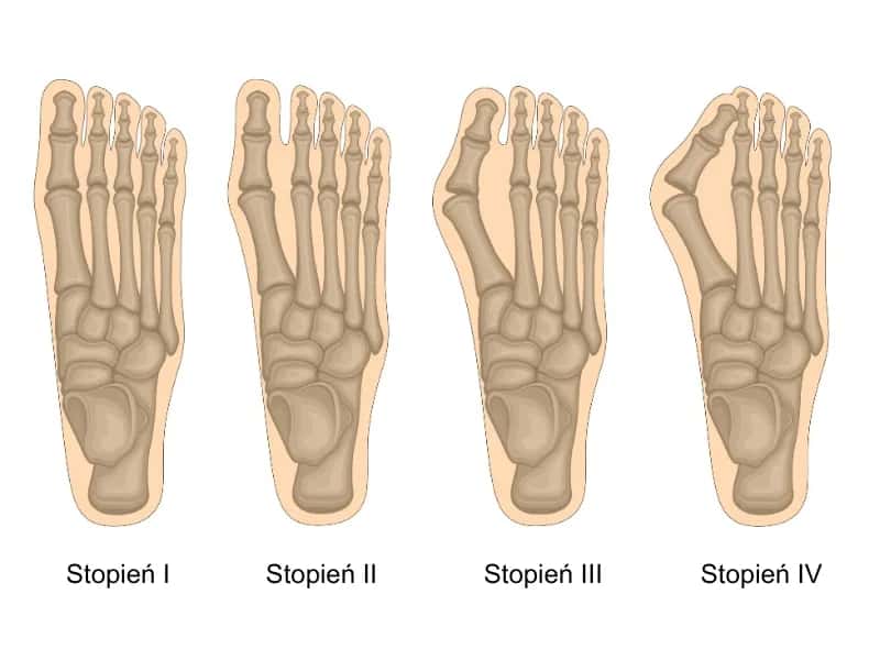 Jak wygląda haluks? Objawy i cechy, które warto znać