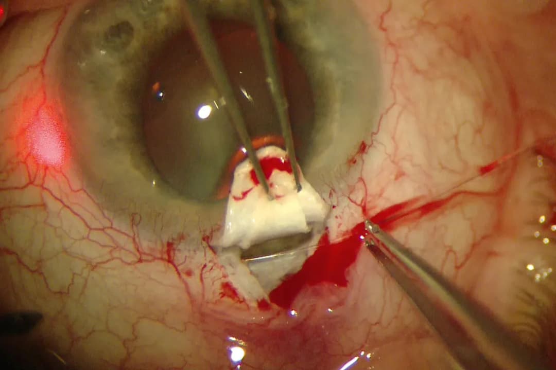 Jak przygotować się do operacji jaskry, aby uniknąć stresu i komplikacji