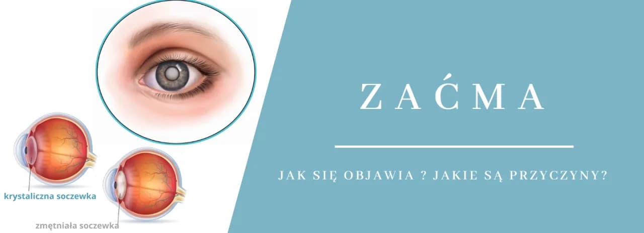 Dlaczego powstaje zaćma? Poznaj przyczyny i jak ich unikać Dlaczego powstaje zaćma? Poznaj przyczyny i jak ich unikać