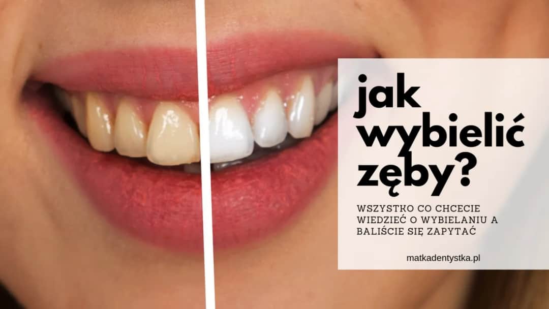 Jak wybielić zęby u dentysty - skuteczne metody i ich koszty