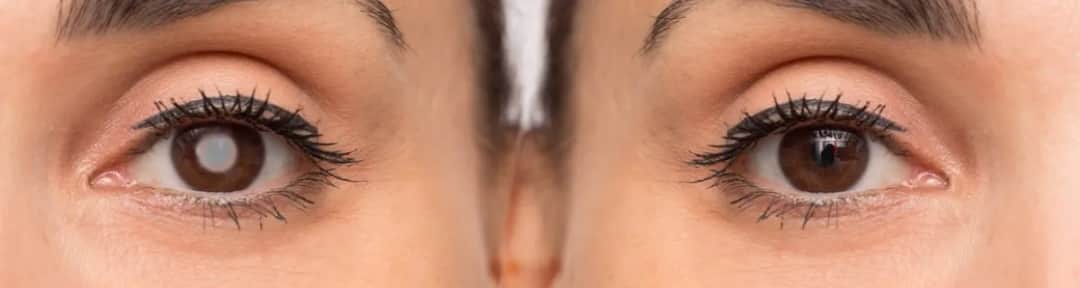 Jak szybko postępuje zaćma? Poznaj niebezpieczeństwa i objawy