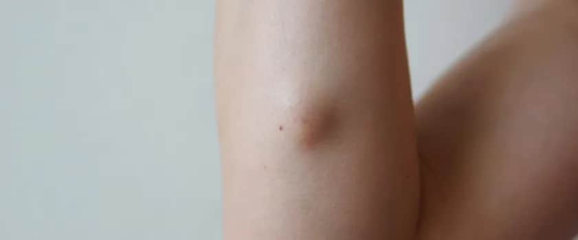 Czy torbiel może pęknąć podczas miesiączki? Objawy i zagrożenia