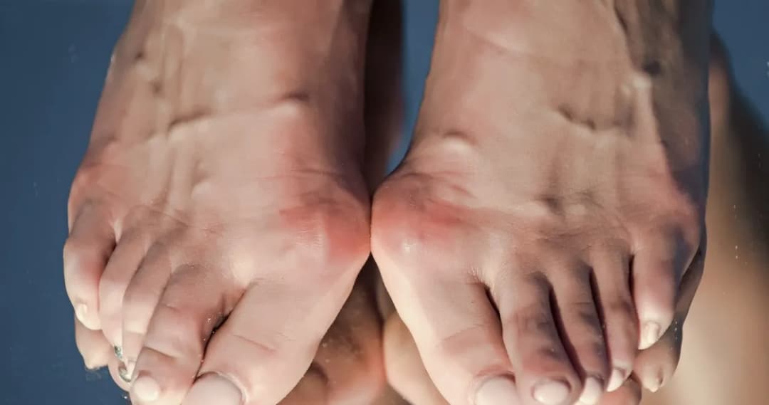 Jak złagodzić ból haluksa - skuteczne domowe metody na ulgę