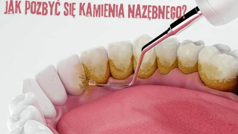 Jak usunąć kamień nazębny bez dentysty - skuteczne metody i pułapki