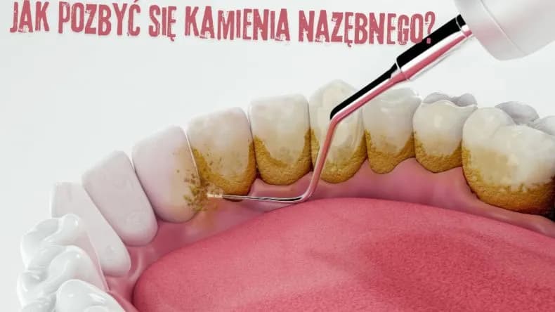 Jak usunąć kamień nazębny bez dentysty - skuteczne metody i pułapki