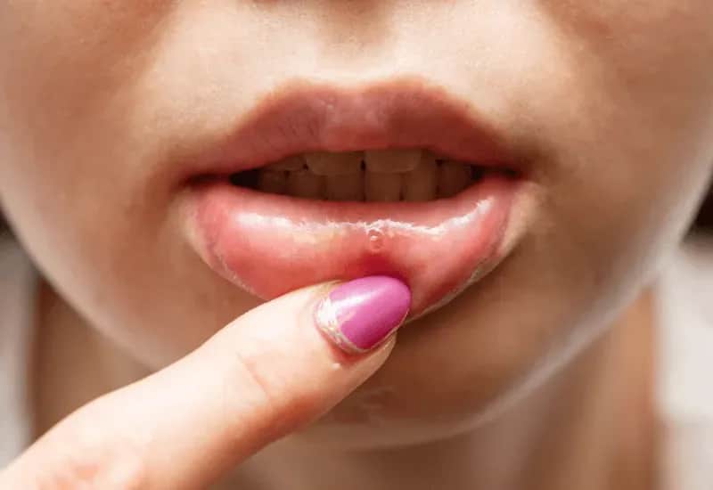 Czy z zimnem można iść do dentysty? Dowiedz się, co grozi