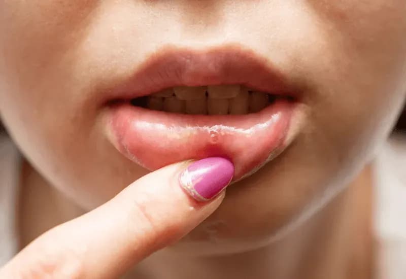 Czy z zimnem można iść do dentysty? Dowiedz się, co grozi