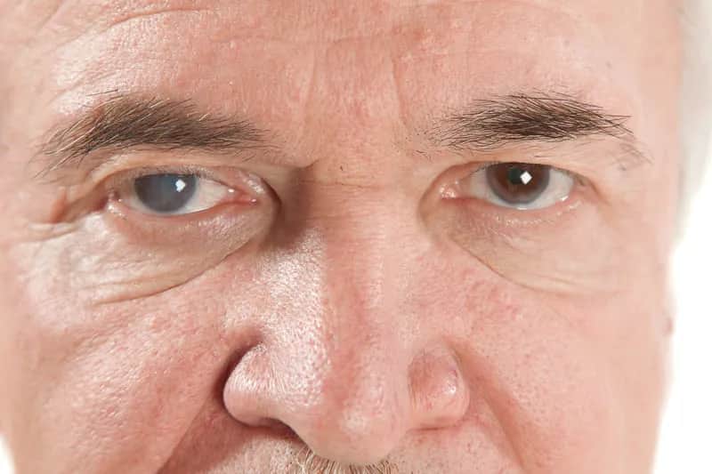 Objawy jaskry wtórnej: jak je rozpoznać i uniknąć poważnych problemów