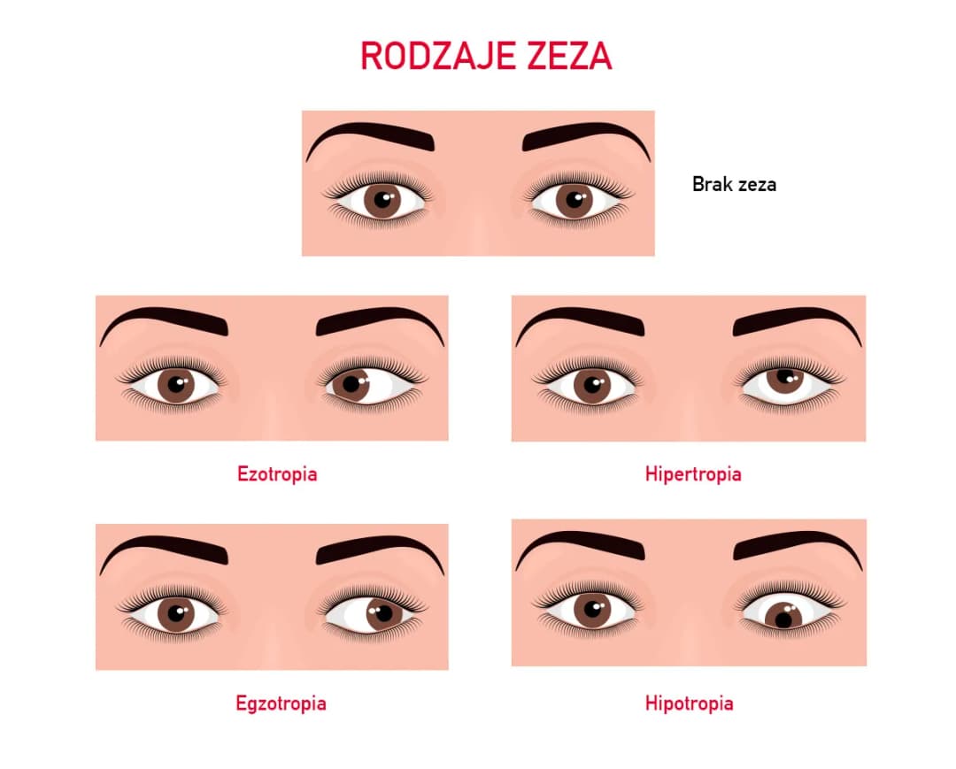 Od czego robi się zez? Poznaj przyczyny i jak ich uniknąć
