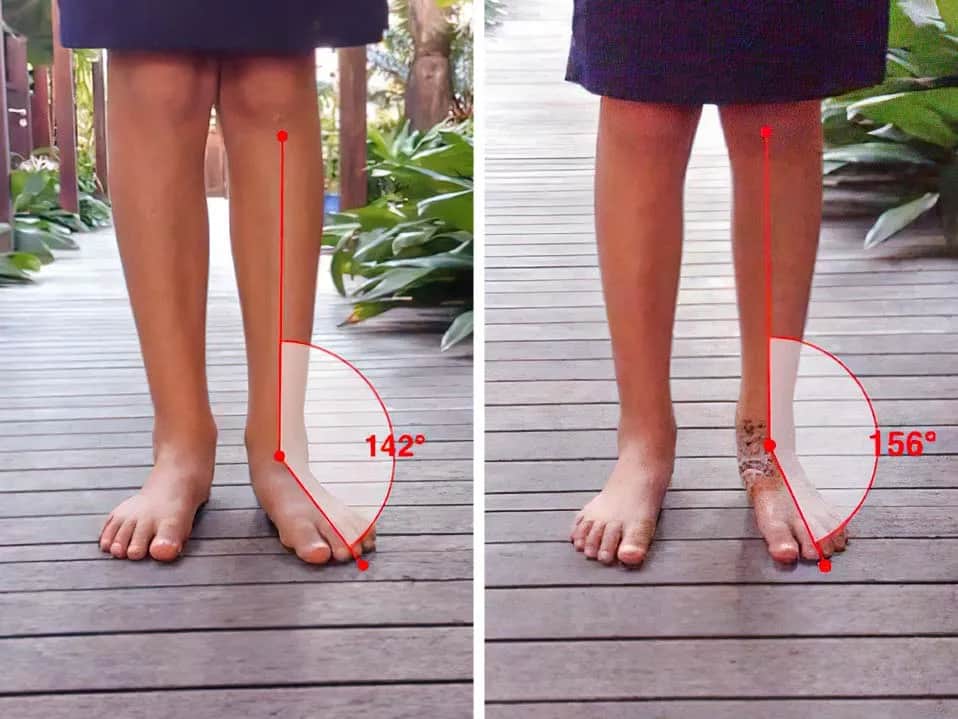 Jak tejpować haluksa, aby złagodzić ból i poprawić komfort stopy