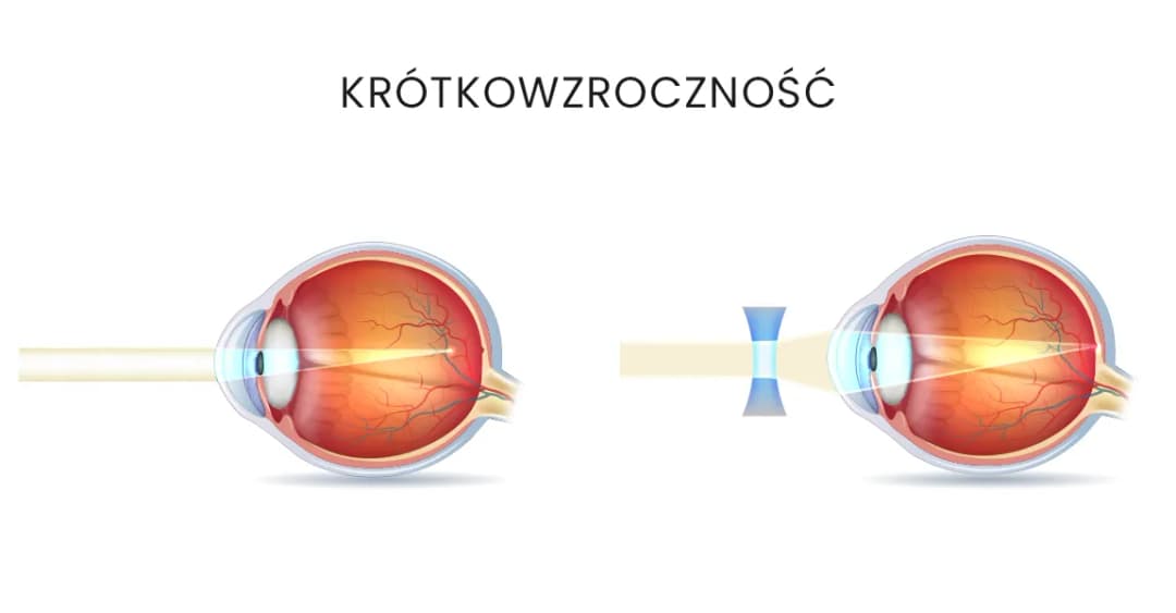 Czy krótkowzroczność można wyleczyć okularami? Prawda o korekcji wzroku