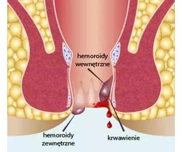 Czy chirurg leczy hemoroidy? Poznaj skuteczne metody leczenia