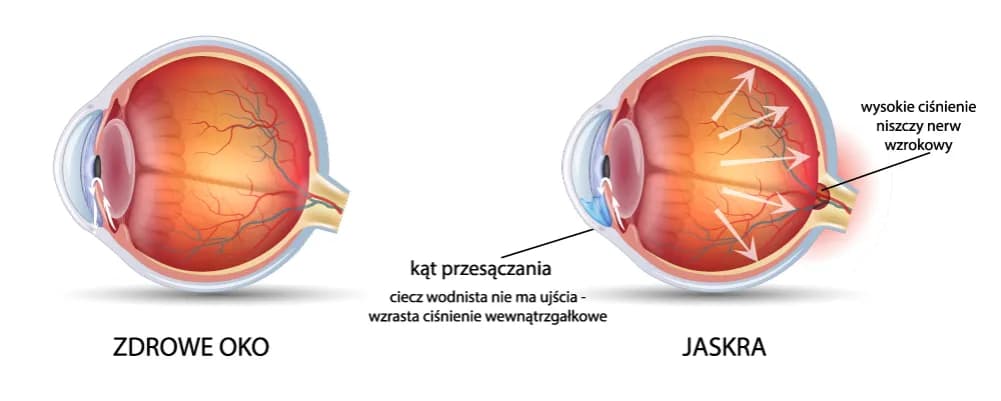 Czego unikać przy jaskrze, aby nie pogorszyć stanu oczu?
