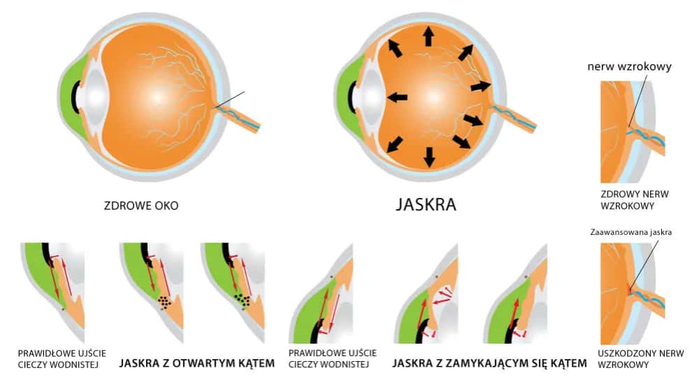 Co to jest jaskra? Poznaj objawy i skutki tej groźnej choroby
