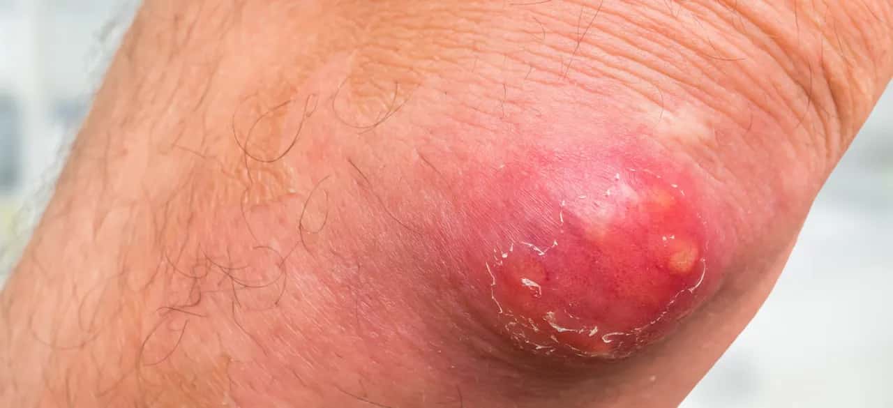 Czyrak dermatolog czy chirurg - kiedy konieczna jest operacja?