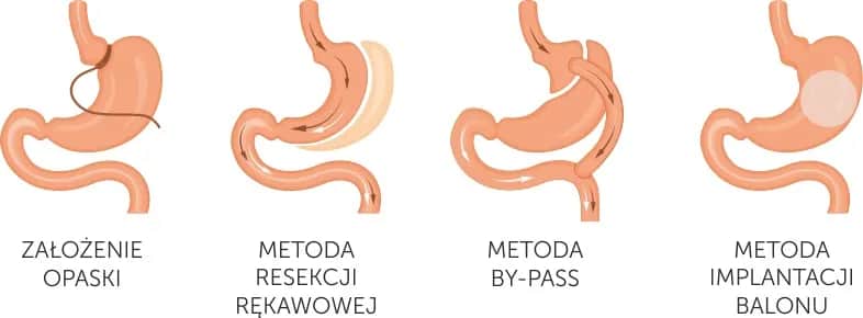 Chirurgia bariatryczna co to? Poznaj skuteczne metody walki z otyłością