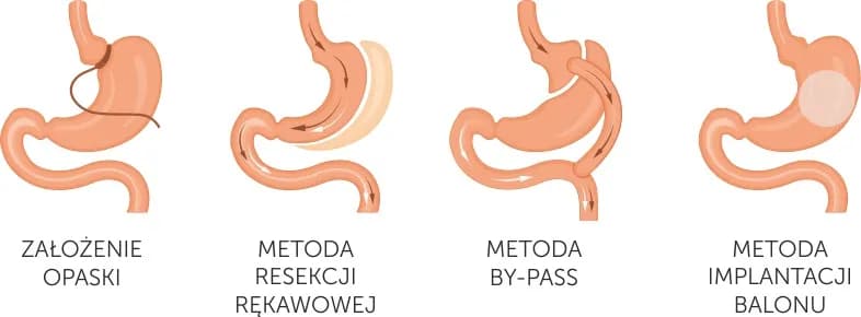 Chirurgia bariatryczna co to? Poznaj skuteczne metody walki z otyłością