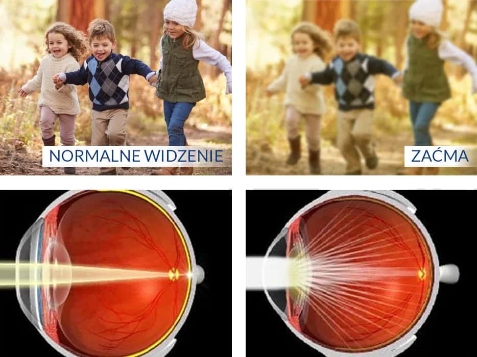 Jak rozpoznać objawy zaćmy i uniknąć utraty wzroku