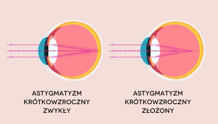 Czy astygmatyzm może się cofnąć? Fakty, które musisz znać